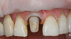 Post In Tooth Root Infected Tooth Root Canal | Dentaris Dental Clinic