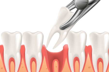 TOOTH-EXTRACTION