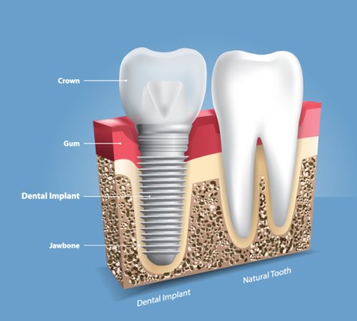 WHAT-IS-A-DENTAL-IMPLANT