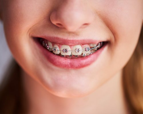 WHICH-DENTAL-ISSUES-CAN-BE-CORRECTED-WITH-DENTAL-BRACES